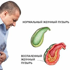 Доклад: Холецистит острое воспаление желчного пузыря